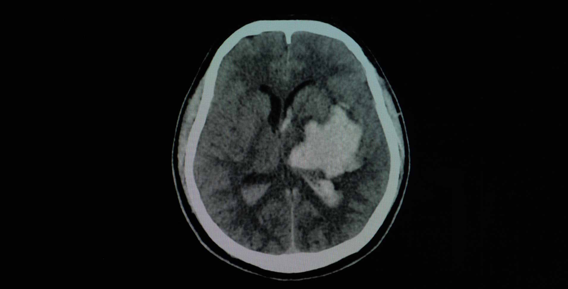 Computertomographie Aufnahme einer Hirnblutung